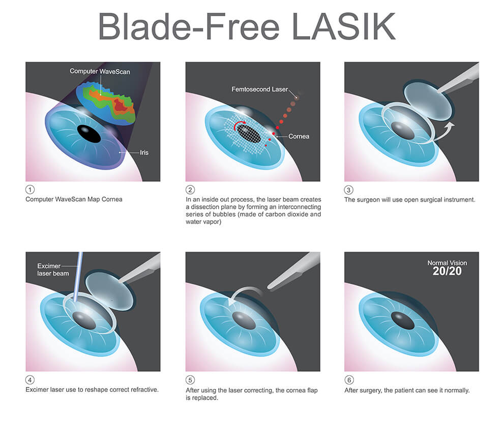 LASIK diagram