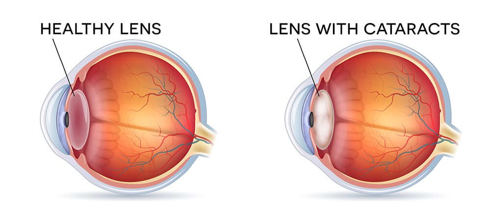 Cataracts Diagram