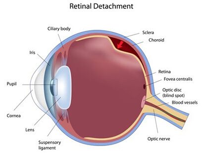 Retinal Detachment