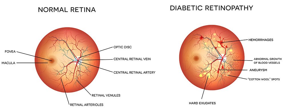 illustration of norma retina vs diabetic retina