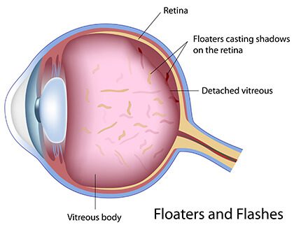 Diagram of Floaters in the eye