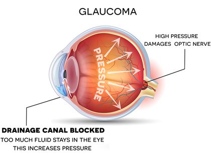 Glaucoma diagram