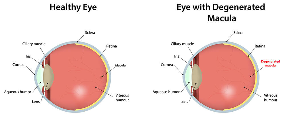 Macular Degeneration diagram